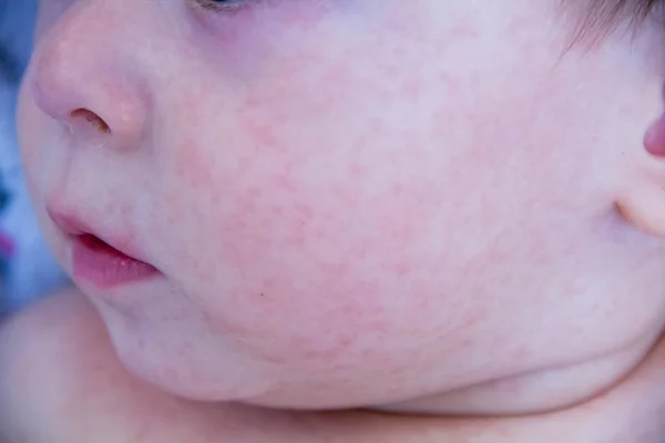 Аллергия детская пища кожного дерматита. сыпь симптомов детского дерматита. лицо спящих новорожденных. страдает атопическим симптомом на щеках кожи. концепция здоровья ребенка — стоковое фото