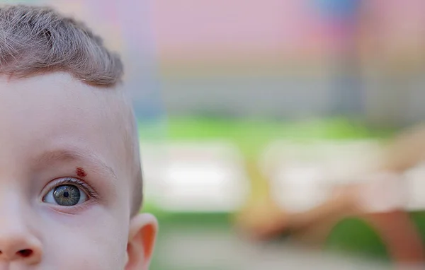 Hematoma on the eye. Bruise on the eye. Bruise of a child,. Pain concept close-up