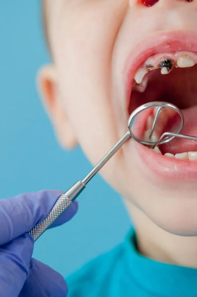 Primo piano delle mani del dentista con assistente in guanti blu stanno trattando i denti di un bambino, il viso del paziente è chiuso — Foto Stock