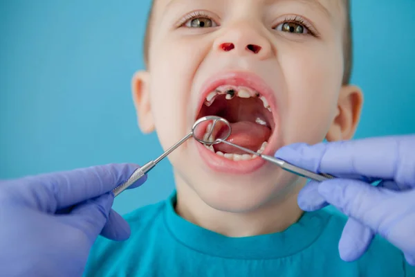 Diş hekimi mavi arka planda çocuğun dişlerini inceliyor. Dişçi koltuğundaki küçük bir hasta gülümsüyor. Dansçı dişleri tedavi eder. Dişçinin dişçi muayenehanesindeki küçük çocuğun dişlerini tedavi ettiği yakın plan.. — Stok fotoğraf