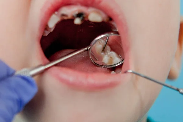 Primo piano delle mani del dentista con assistente in guanti blu stanno trattando i denti di un bambino, il viso del paziente è chiuso — Foto Stock