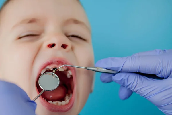 Primo piano delle mani del dentista con assistente in guanti blu stanno trattando i denti di un bambino, il viso del paziente è chiuso — Foto Stock