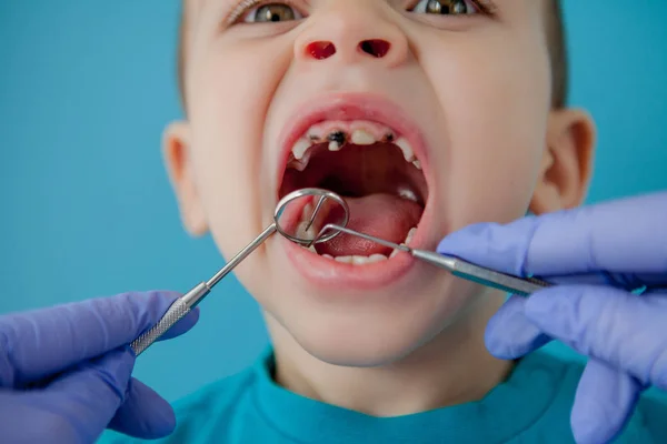 Primo piano delle mani del dentista con assistente in guanti blu stanno trattando i denti di un bambino, il viso del paziente è chiuso — Foto Stock