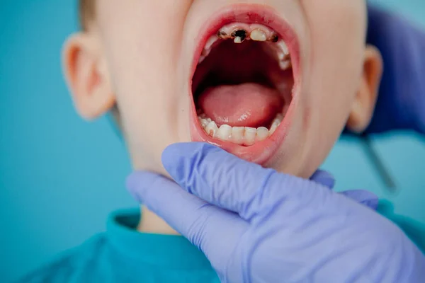 Mavi eldivenli asistanla dişçi ellerini kapatıyorlar. Çocuğa diş tedavisi uyguluyorlar. Hastanın yüzü kapalı. — Stok fotoğraf