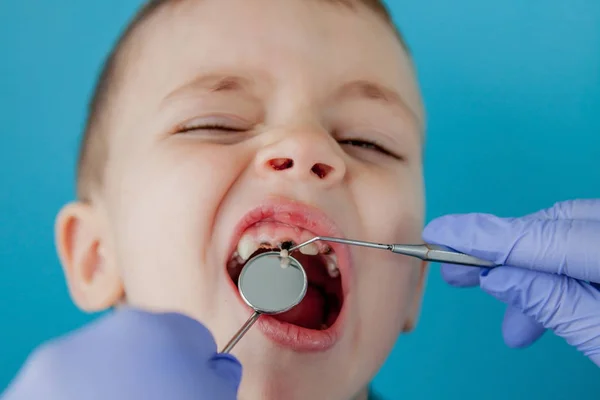 Primo piano dei dentisti mani con assistente in guanti blu stanno trattando i denti a un bambino, il volto dei pazienti è chiuso — Foto Stock