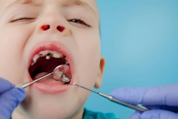 Mavi Eldivenli Asistanla Dişçi Ellerini Kapatıyorlar Çocuğa Diş Tedavisi Uyguluyorlar — Stok fotoğraf