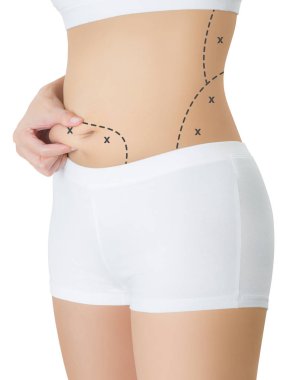kadının karnı siyah renk ile ciltte kapma işaretleme, kaybetmek ağırlık ve liposuction selülit kaldırma kavramı, göl kenarında beyaz arka plan üzerinde haçlar.