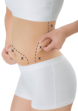 kalça ve göbek siyah renk ile cilt kapma kadın işaretleme, kaybetmek ağırlık ve liposuction selülit kaldırma kavramı, göl kenarında beyaz arka plan üzerinde haçlar.