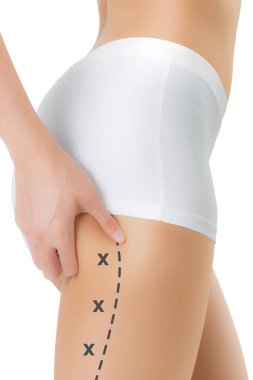 Cilt üzerinde siyah renk ile onun kalça kapma kadın işaretleme, kaybetmek ağırlık ve liposuction selülit kaldırma kavramı, göl kenarında beyaz arka plan üzerinde haçlar.