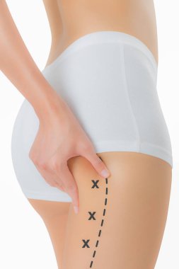 Cilt üzerinde siyah renk ile onun kalça kapma kadın işaretleme, kaybetmek ağırlık ve liposuction selülit kaldırma kavramı, göl kenarında beyaz arka plan üzerinde haçlar.
