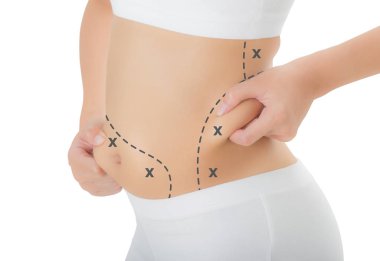 Kadın kalçası ciltte kapma kapatın ve işaretleme, kaybetmek ağırlık ve liposuction selülit kaldırma kavramı, göl kenarında beyaz arka planda siyah renk göbekle haçlar.