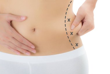 Kadın onun kanatları siyah renk ile ciltte kapma yakından işaretleme, kaybetmek ağırlık ve liposuction selülit kaldırma kavramı, göl kenarında beyaz arka plan üzerinde haçlar.