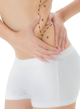Kadın onun kanatları siyah renk ile ciltte kapma işaretleme, kaybetmek ağırlık ve liposuction selülit kaldırma kavramı, göl kenarında beyaz arka plan üzerinde haçlar.