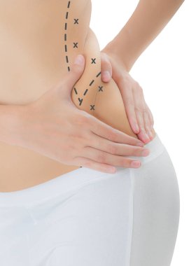 Kadın onun kanatları siyah renk ile ciltte kapma yakından işaretleme, kaybetmek ağırlık ve liposuction selülit kaldırma kavramı, göl kenarında beyaz arka plan üzerinde haçlar.