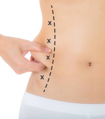Kadın onun kanatları siyah renk ile ciltte kapma işaretleme, kaybetmek ağırlık ve liposuction selülit kaldırma kavramı, göl kenarında beyaz arka plan üzerinde haçlar.