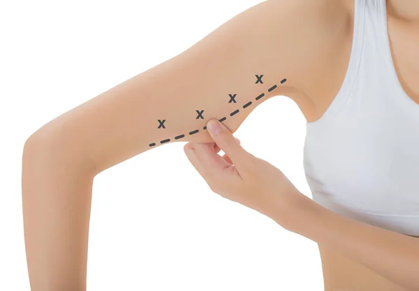 Vrouw grijpen huid op haar bovenarm met de zwarte kleur kruist markering, verliezen gewicht en liposuctie cellulitis verwijdering concept, geïsoleerd op witte achtergrond. — Stockfoto