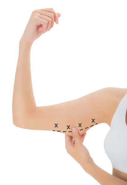 işaretleme, kaybetmek ağırlık ve liposuction selülit kaldırma kavramı, göl kenarında beyaz arka planda siyah renk ile üst kolu ciltte kapma kadın haçlar.