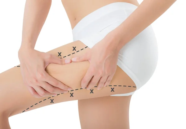 cilt üzerinde siyah renk ile onun kalça kapma kadın işaretleme, kaybetmek ağırlık ve liposuction selülit kaldırma kavramı, göl kenarında beyaz arka plan üzerinde haçlar.