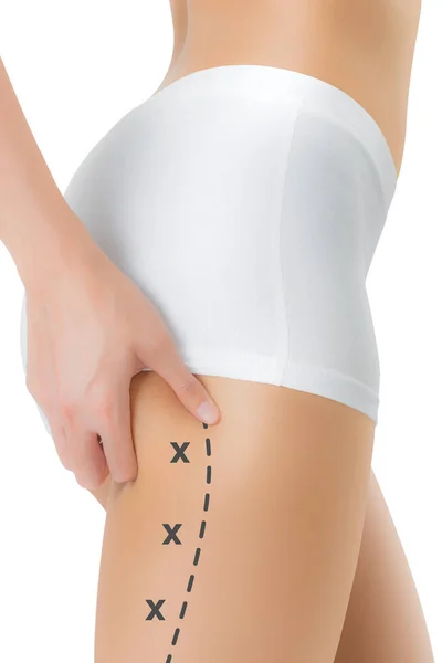 Cilt üzerinde siyah renk ile onun kalça kapma kadın işaretleme, kaybetmek ağırlık ve liposuction selülit kaldırma kavramı, göl kenarında beyaz arka plan üzerinde haçlar.