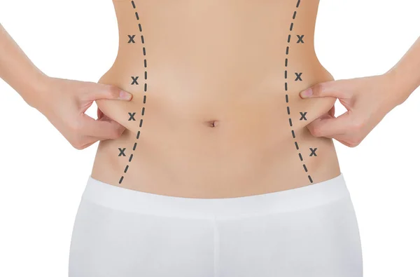 Kadın onun kanatları siyah renk ile ciltte kapma işaretleme, kaybetmek ağırlık ve liposuction selülit kaldırma kavramı, göl kenarında beyaz arka plan üzerinde haçlar.