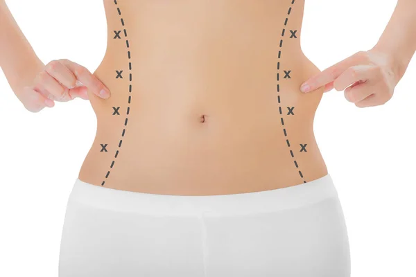 Kadın onun kanatları siyah renk ile ciltte kapma işaretleme, kaybetmek ağırlık ve liposuction selülit kaldırma kavramı, göl kenarında beyaz arka plan üzerinde haçlar.