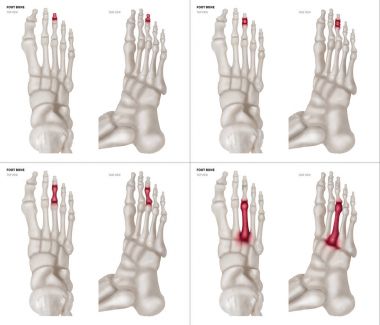 Koleksiyon orta ayak ayak kemik kırmızı olayları farklı ağrı ile x-ışını ve ortak alan-üst ve yan görünümü-sağlık-insan anatomisi ve tıbbi izole kavramı-beyaz arka plan üzerinde.