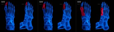 Ayak başparmağı ayak kemik kırmızı olayları farklı ağrı ile mavi film koleksiyonu x-ışını ve ortak alan-üst ve yan görünümü-sağlık-insan anatomisi ve tıbbi izole kavramı-siyah arka plan üzerine.