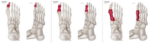 X-ray samling av stortån fot ben med röda höjdpunkter på olika smärta och gemensamma område-topp och sida Visa-sjukvård-Human anatomi och medicinska begrepp-isolerade på vit bakgrund. — Stockfoto