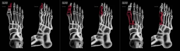 X-ray film kolekcji kości palucha stopy z czerwono podkreśla na różne bóle i wspólnego obszaru górnej i bocznych anatomia człowieka-opieka zdrowotna widok i medycyna koncepcja na białym na czarnym tle. — Zdjęcie stockowe