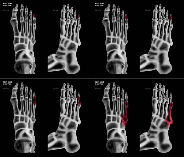 Colección de radiografías de Little toe foot bone con reflejos rojos en diferentes dolor y área articular-parte superior y vista lateral-Salud-Anatomía humana y concepto médico-Aislado sobre fondo negro . — Foto de Stock