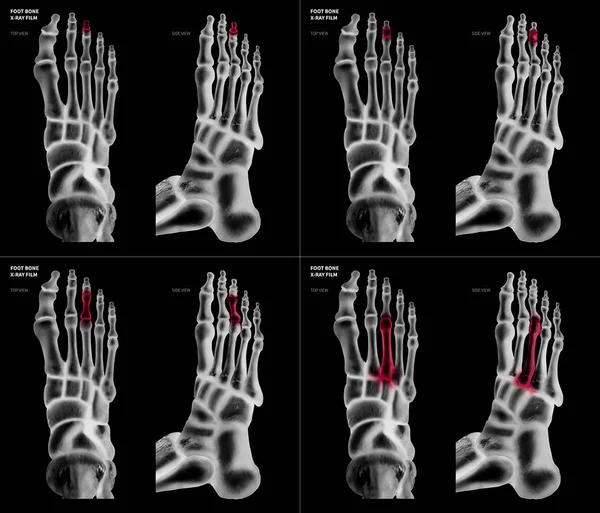 Colección de radiografías de hueso del pie del dedo medio del pie con reflejos rojos en diferentes dolor y área articular-superior y vista lateral-Cuidado de la salud-Anatomía humana y concepto médico-Aislado sobre fondo negro . — Foto de Stock