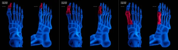 X-ray blue film collection of Big toe foot bone with red highlights on different pain and joint area-top and side view-Healthcare-Human Anatomy and Medical concept-Isolated on black background.