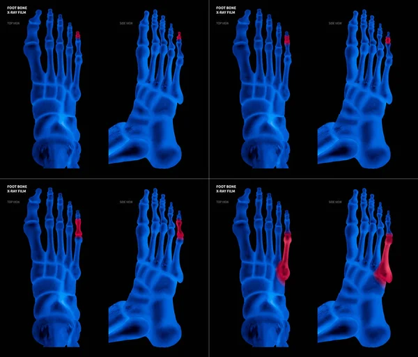 Colección de película azul de rayos X de Little toe foot bone con reflejos rojos en diferentes dolor y área articular-parte superior y vista lateral-Healthcare-Human Anatomy and Medical concept-Aislado sobre fondo negro . — Foto de Stock