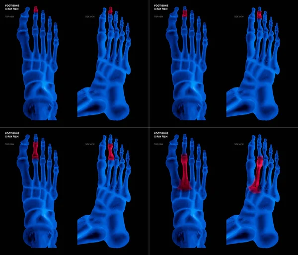 Colección de película azul de rayos X de hueso del pie largo con reflejos rojos en diferentes dolor y área articular-superior y vista lateral-Cuidado de la salud-Anatomía humana y concepto médico-Aislado sobre fondo negro . — Foto de Stock
