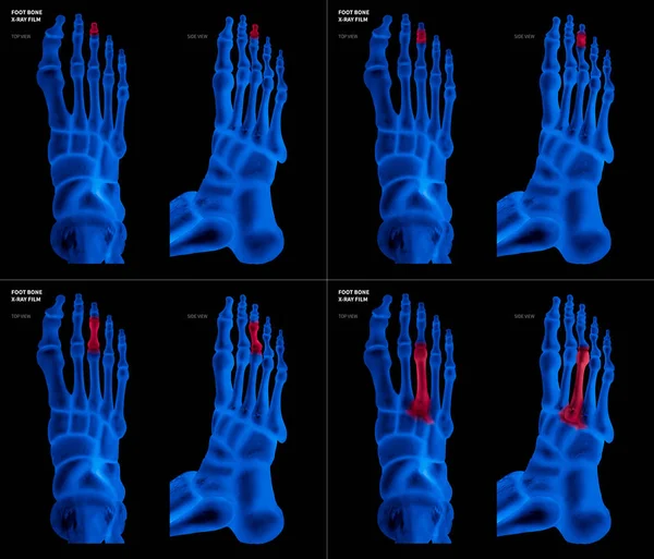Colección de película azul de rayos X de hueso del pie del dedo medio del pie con reflejos rojos en diferentes dolor y área articular-superior y vista lateral-Cuidado de la salud-Anatomía humana y concepto médico-Aislado sobre fondo negro . — Foto de Stock