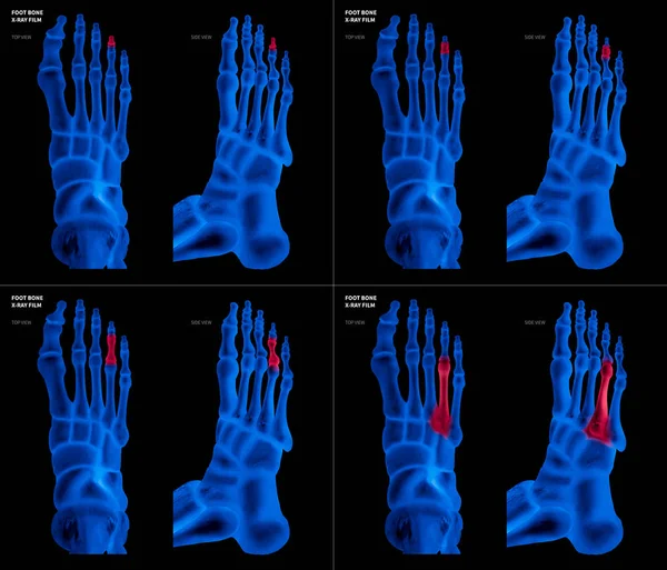 Colección de película azul de rayos X de hueso del pie del anillo con reflejos rojos en diferentes dolor y área articular-parte superior y vista lateral-Cuidado de la salud-Anatomía humana y concepto médico-aislado sobre fondo negro . — Foto de Stock