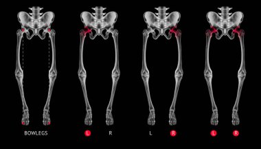 Varus hizalama veya Bowlegs kemik röntgen film koleksiyonu ile kırmızı olayları Hip artrit ve Kalça eklemi alan-sağlık-insan anatomisi ve tıbbi izole kavramı-siyah arka plan üzerine.