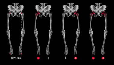 Varus alignment of leg or Bowlegs bone X-ray film collection with red highlights on Hip Arthritis and hip joint area-Healthcare-Human Anatomy and Medical concept-Isolated on black background. clipart