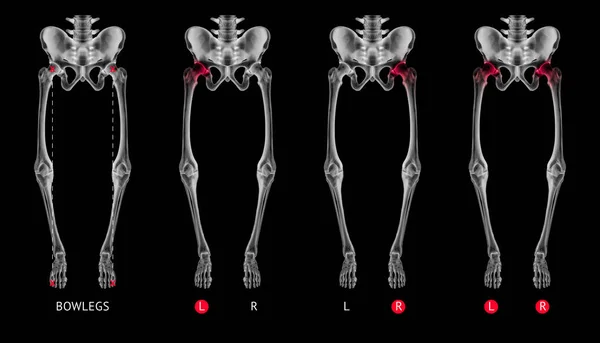 Varo allineamento della gamba o Bowlegs osso collezione di film a raggi X con riflessi rossi su artrite anca e anca zona articolare-Sanità-Anatomia umana e concetto medico-isolato su sfondo nero . — Foto Stock