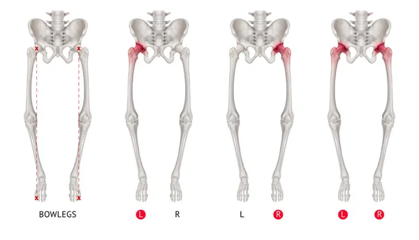 Varo allineamento della collezione di gambe o Bowlegs osso con riflessi rossi su Artrite anca e area articolare dell'anca-Sanità-Anatomia umana e concetto medico-isolato su sfondo bianco . — Foto Stock