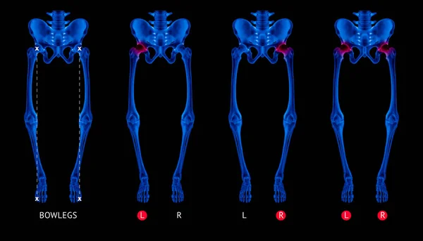 Varus anpassning av ben eller Bowlegs ben röntgen blå filmsamling med röda höjdpunkter på höft artrit och höftleden område-sjukvård-Human anatomi och medicinska begrepp-isolerade på svart bakgrund. — Stockfoto