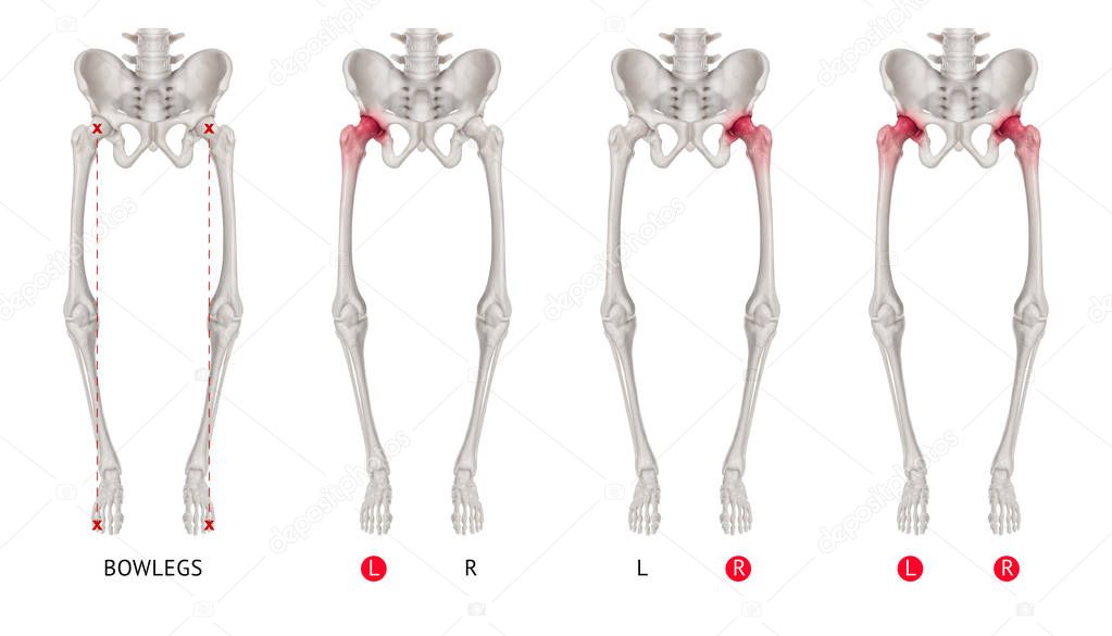 Varus alignment of leg or Bowlegs bone collection with red highlights on Hip Arthritis and hip joint area-Healthcare-Human Anatomy and Medical concept-Isolated on white background.
