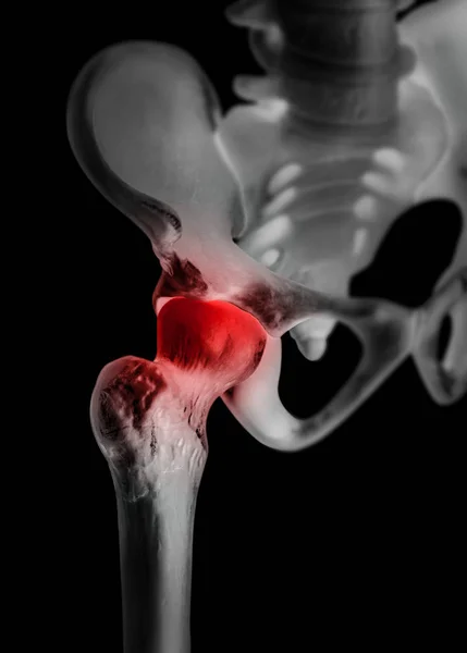 Mänskliga höftleden med rött Markera på smärta område - X ray film-sjukvård-Human anatomi och medicinska begrepp-isolerade på svart bakgrund. — Stockfoto