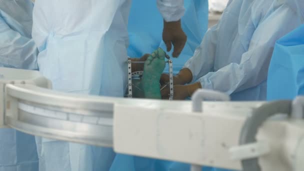 Operação cirúrgica. Doutor perfura pacientes pé com chave de fenda. Cirurgia real . — Vídeo de Stock