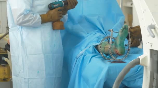 Fractura ósea. Equipo médico en el quirófano del hospital realizando la operación  . — Vídeo de stock