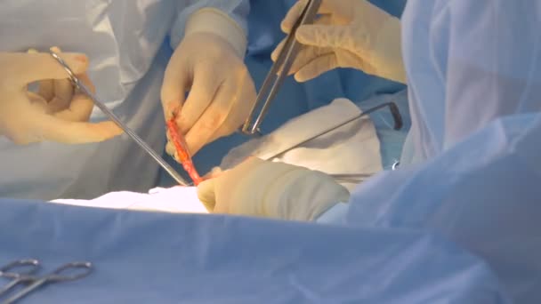 외과 팀 손 수술을 수행. 클로즈업. — 비디오