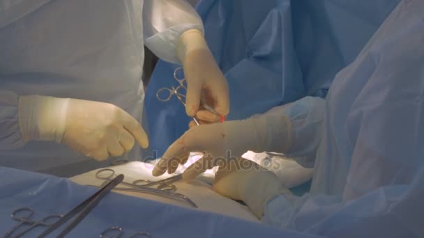 外科医は、手の手術を行うチームします。クローズ アップ. — ストック動画