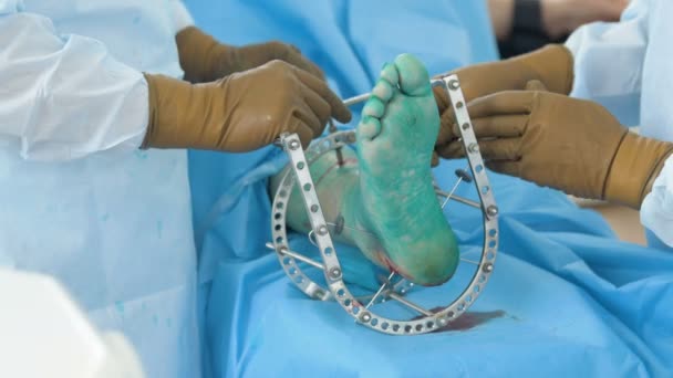 Cirurgia da perna partida. Médico aparafusar agulhas, pinos de metal na perna . — Vídeo de Stock