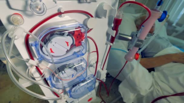 Patient during hemodialysis procedure. Modern dialysis machines making blood purification. — Stock Video