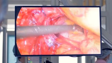 Laparoskopi sırasında çıkarılan iç organ doku video yem.